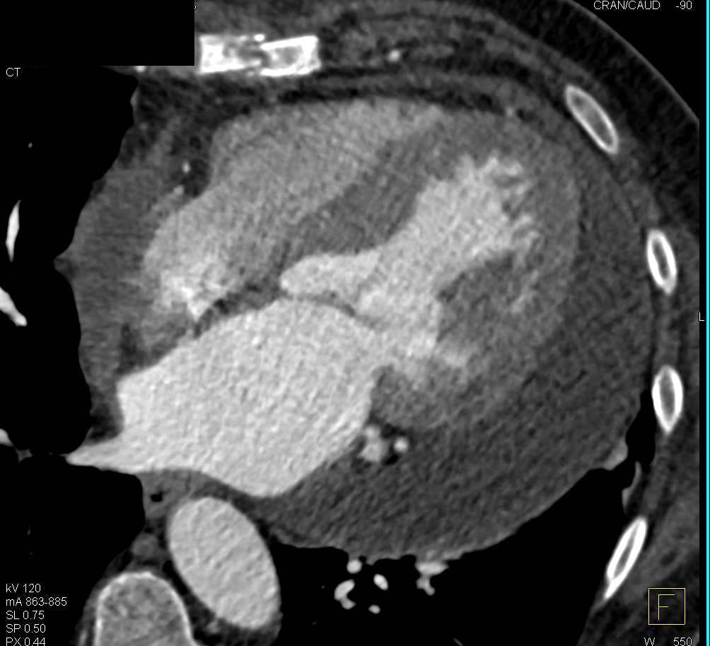 Large Pericardial Effusion in a Patient with Aortic Valve Replacement - CTisus CT Scan