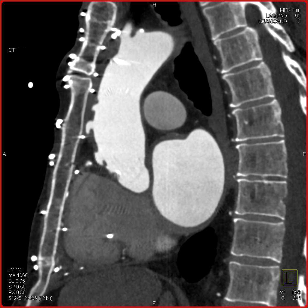 Multiple Bypass Grafts off the Ascending Aorta - CTisus CT Scan