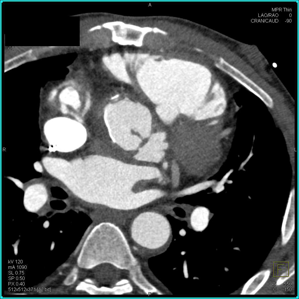 Pseudoaneurysm Following Aortic Root Repair - CTisus CT Scan