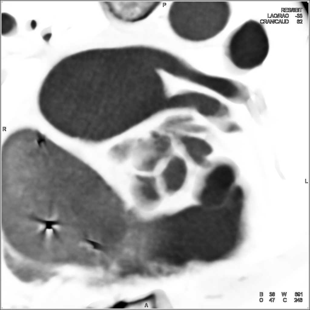 Pseudoaneurysm Following Aortic Root Repair - CTisus CT Scan
