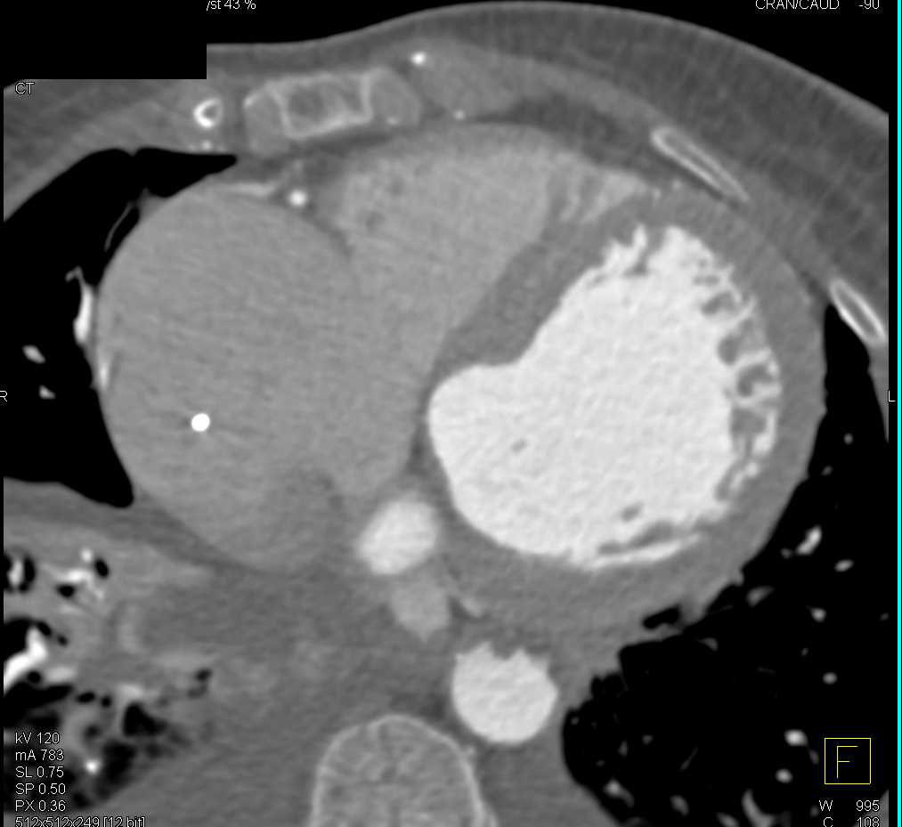 Pulmonary Emboli Right Lower Lobe Arteries on Triple Rule Out Study - CTisus CT Scan