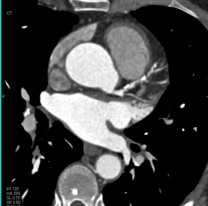 CCTA: Critical Stenosis in Multiple Vessels Including Right Coronary Artery (RCA) and Left Anterior Descending Coronary Artery (LAD) - CTisus CT Scan