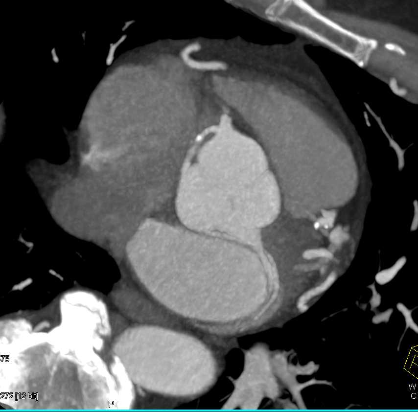 CCTA: Calcified Plaque Left Anterior Descending Coronary Artery (LAD) Without Critical Stenosis - CTisus CT Scan
