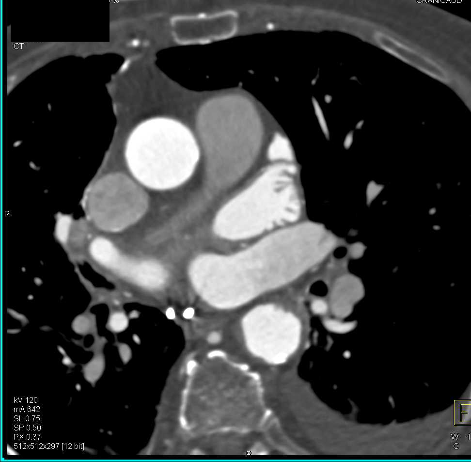 CCTA with Left and Right Main Coronary Artery off a Single Trunk - CTisus CT Scan