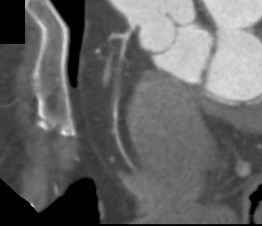 CCTA with Near Occlusion of Right Coronary Artery - CTisus CT Scan