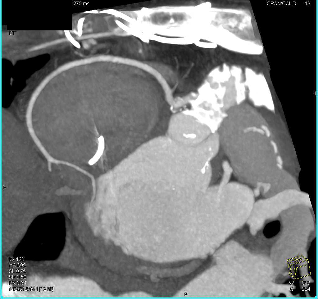 CCTA: Minimal Plaque in Left Anterior Descending Coronary Artery - CTisus CT Scan