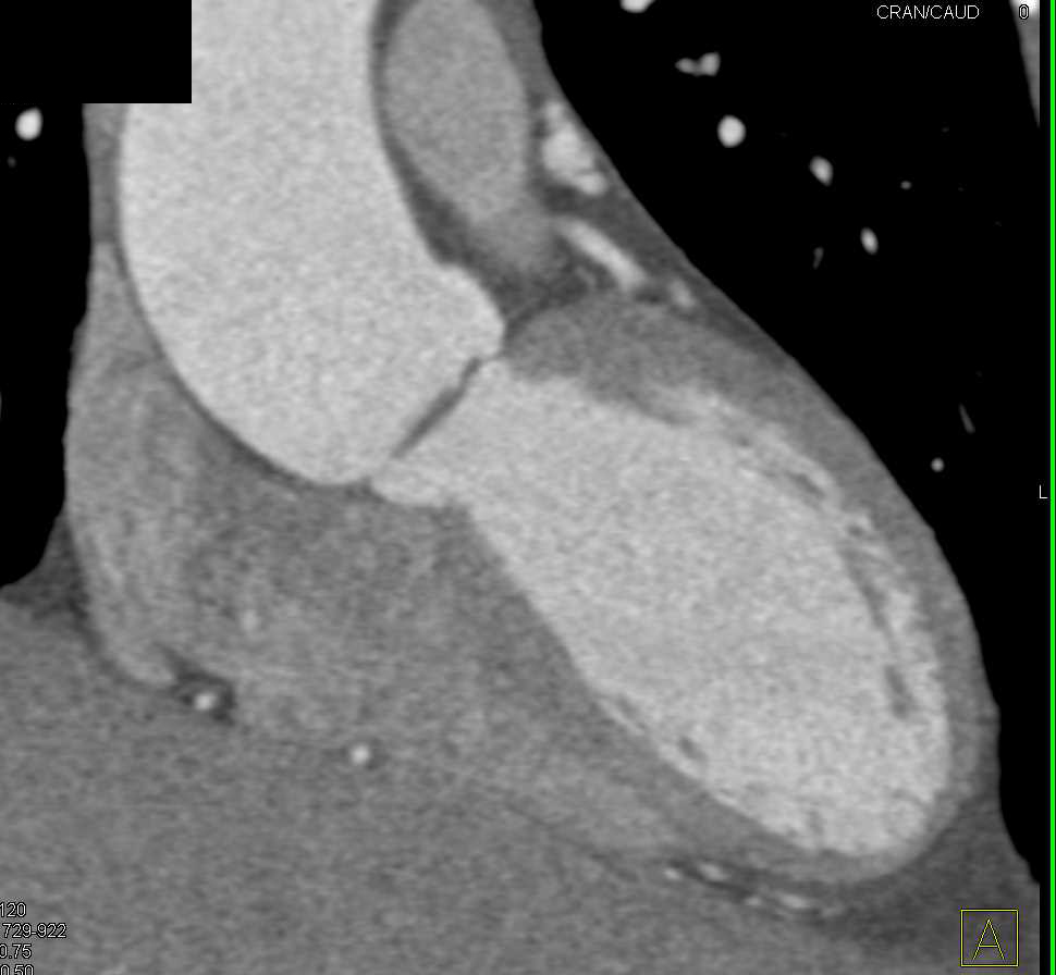 Bicuspid Aortic Valve - CTisus CT Scan