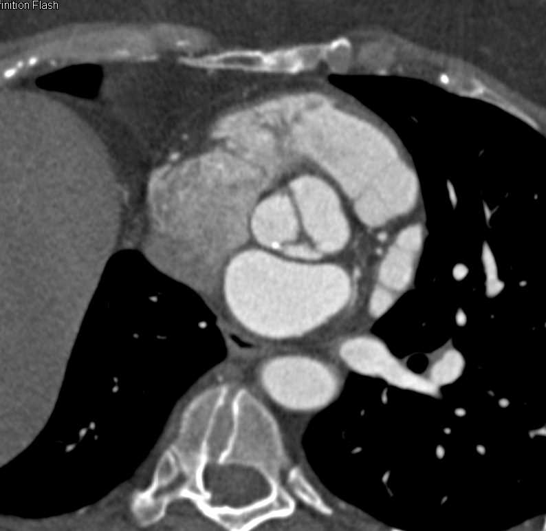 Bicuspid Aortic Valve with Dilated Ascending Aorta - CTisus CT Scan