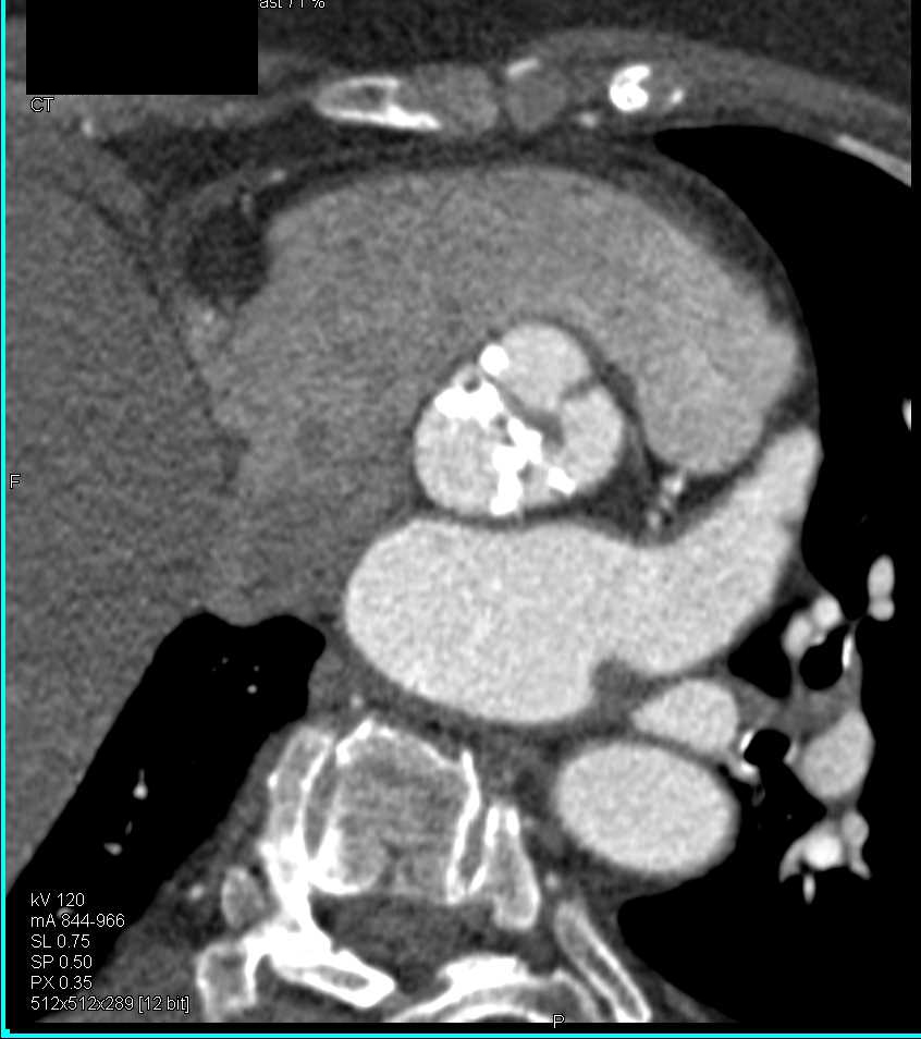Aortic Valve Calcification and Stenosis - CTisus CT Scan