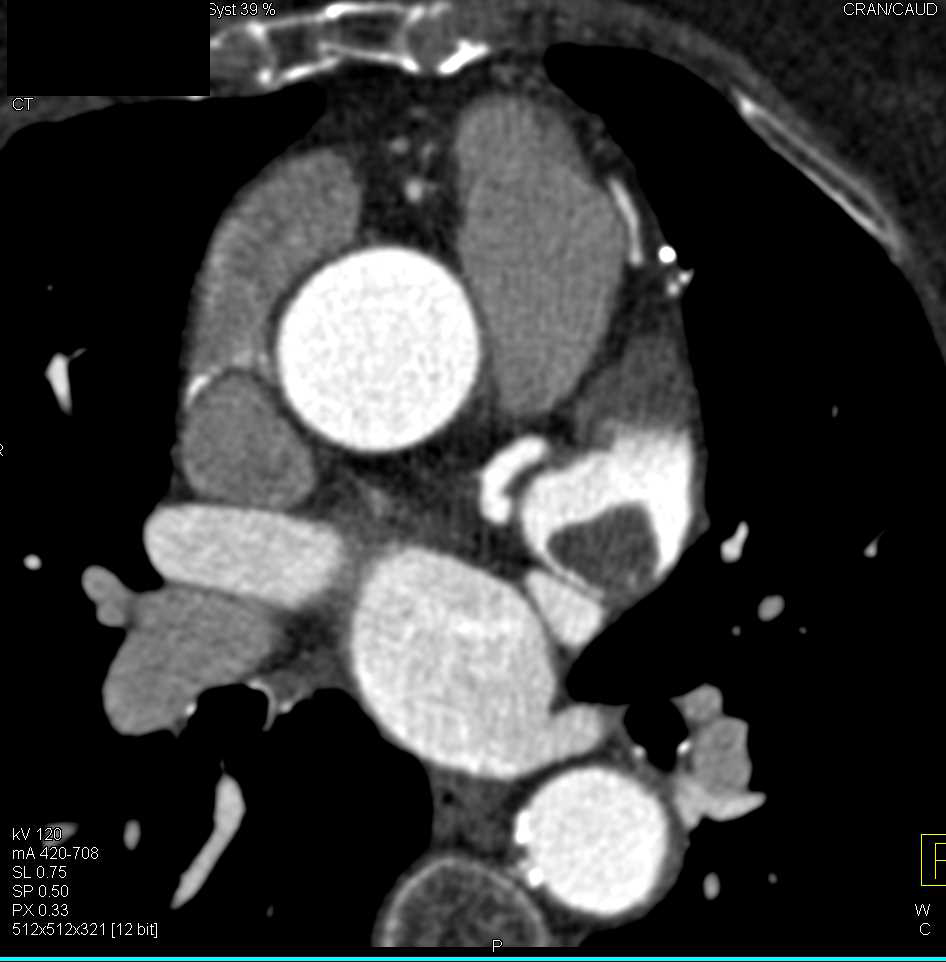Left Atrial Thrombus - CTisus CT Scan