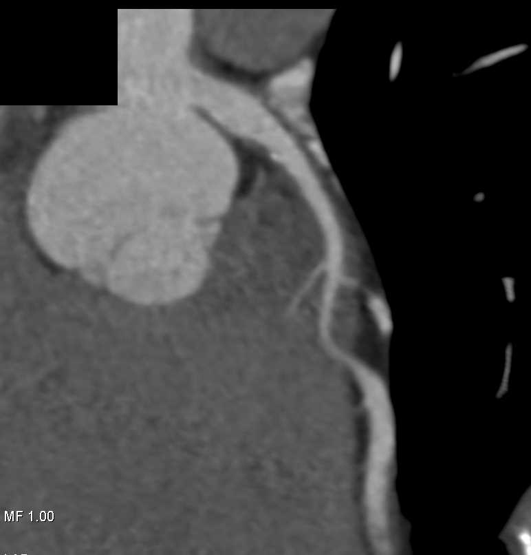 CCTA with Left Anterior Descending Coronary Artery (LAD) Stenosis - CTisus CT Scan