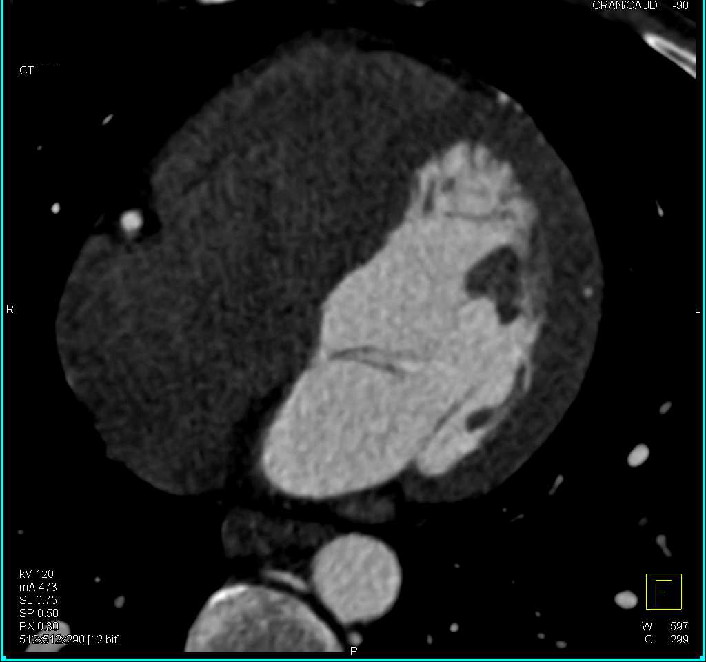 CCTA with Circumflex Coronary Artery Arising off Right Coronary Artery (RCA) and Tracking Behind the Heart - CTisus CT Scan