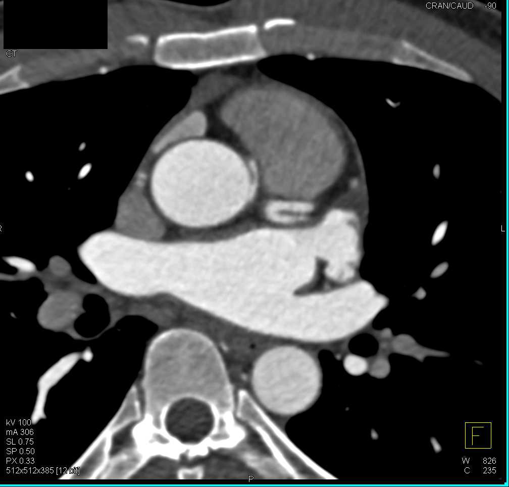 CCTA: Right Coronary Artery Arises off Left Cusp in a Malignant Configuration - CTisus CT Scan