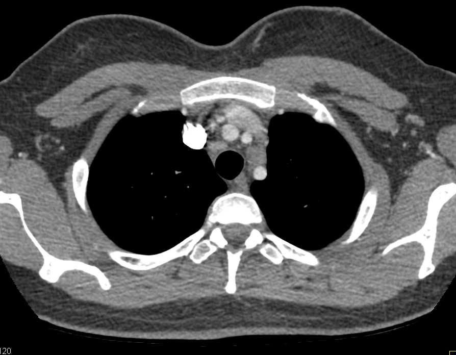 Lymphoma Left Chest Involves the Heart - CTisus CT Scan