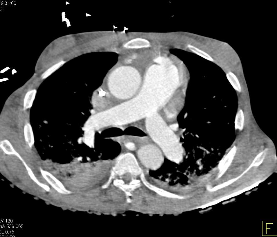 Poor Cardiac Function with Reflux into the Inferior Vena Cava (IVC) and Hepatic Veins - CTisus CT Scan