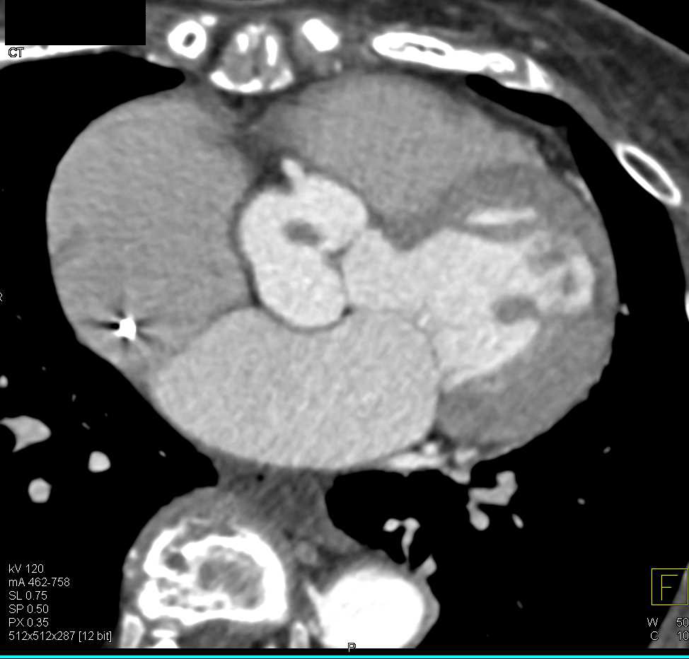 Fibroelastoma on the Aortic Valve - CTisus CT Scan