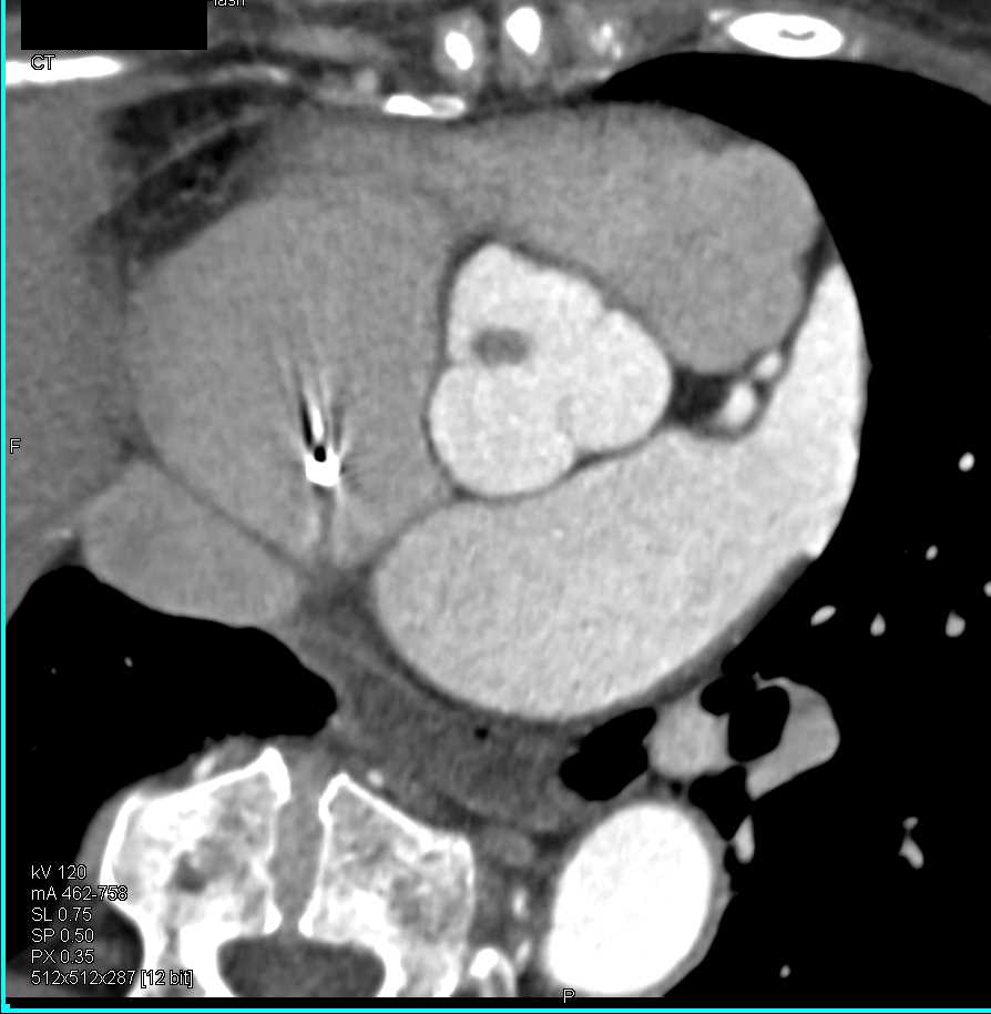 Fibroelastoma on the Aortic Valve - CTisus CT Scan