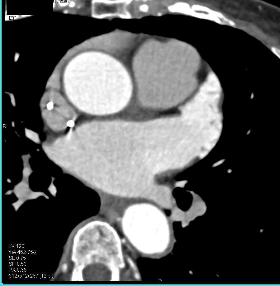 Fibroelastoma on the Aortic Valve - CTisus CT Scan