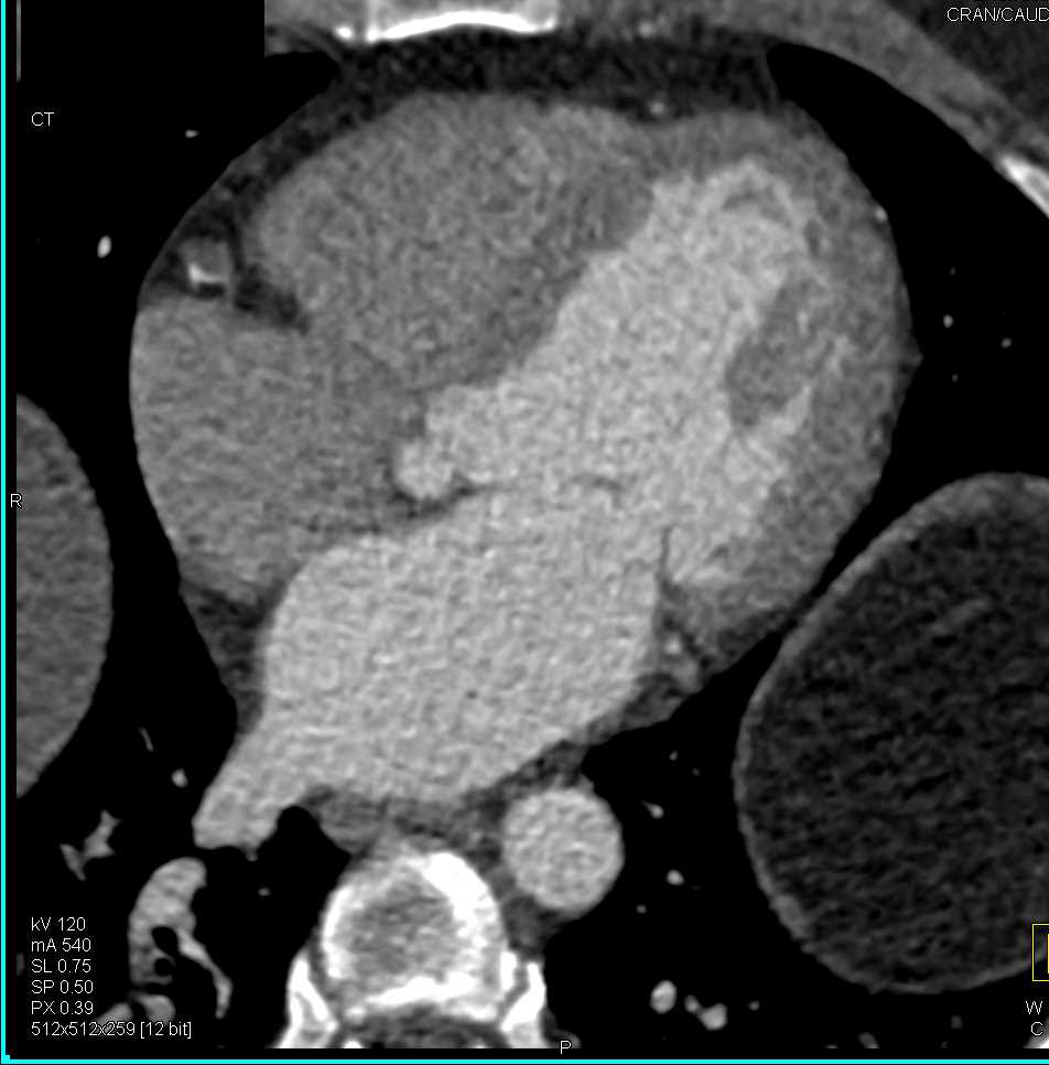 Cardiac CTA with Occluded Right Coronary Artery - CTisus CT Scan