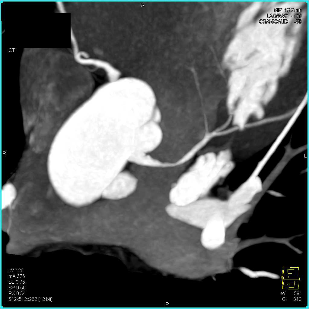 Multiple Pulmonary Emboli (PEs) and Left Anterior Descending Coronary Artery (LAD) Stenosis of Over 50% - CTisus CT Scan