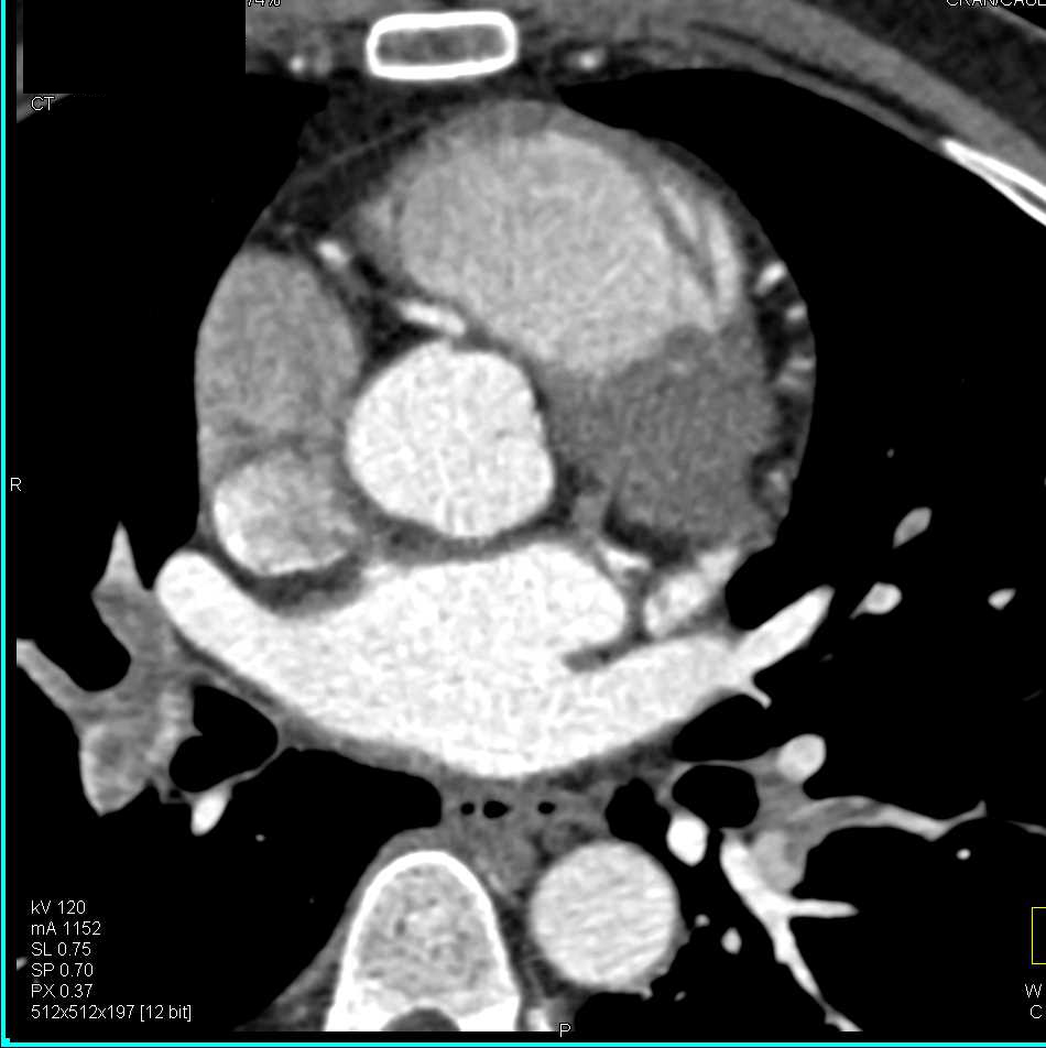 Multiple Pulmonary Emboli (PEs) and Left Anterior Descending Coronary Artery (LAD) Stenosis of Over 50% - CTisus CT Scan