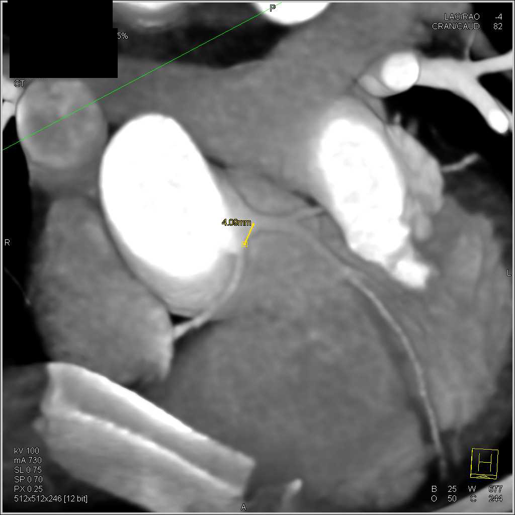 CCTA with Right Coronary Artery off the Left Cusp - CTisus CT Scan