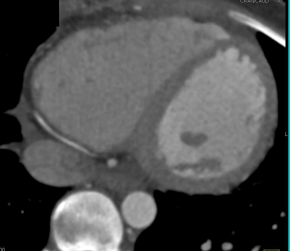 Right Coronary Artery (RCA) Arises off the Left Cusp in Malignant Configuration - CTisus CT Scan