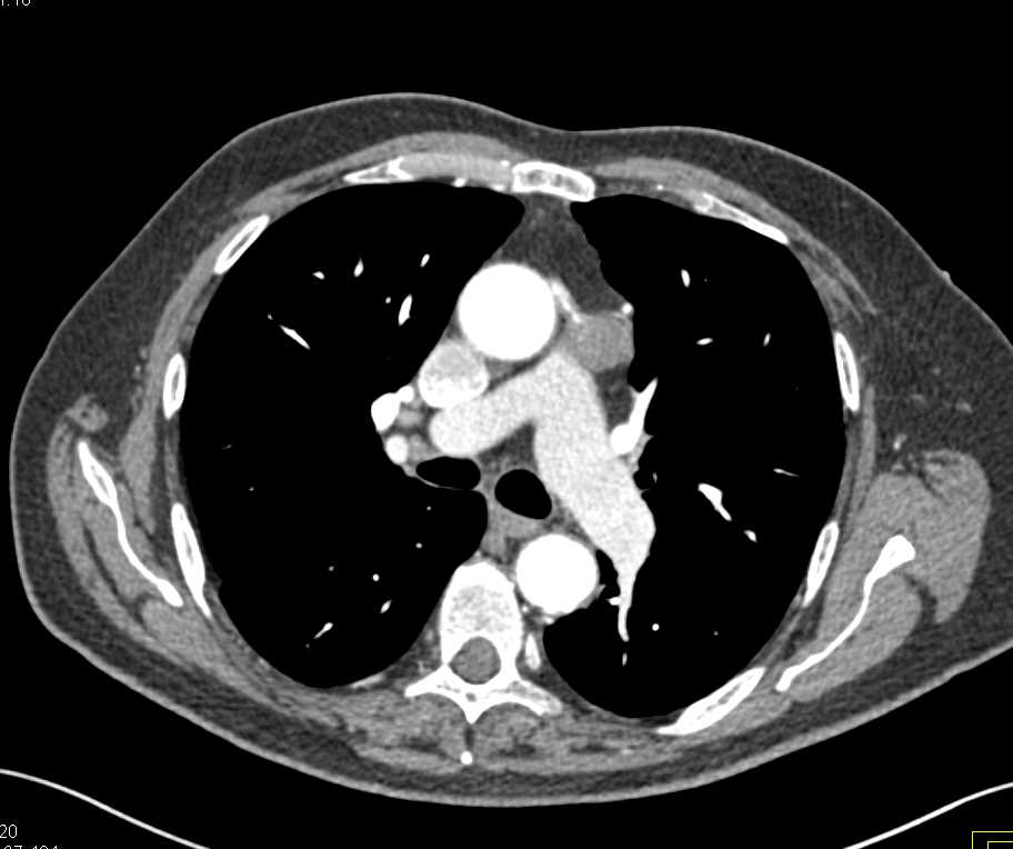 Coronary Artery Aneurysm from a Graft - CTisus CT Scan