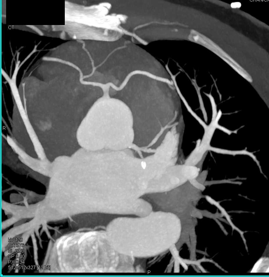 CCTA: Right Coronary Artery (RCA) and Duplicated Left Coronary Artery Arise from a Common Trunk and Plaque in Left Anterior Descending Artery (LAD) - CTisus CT Scan