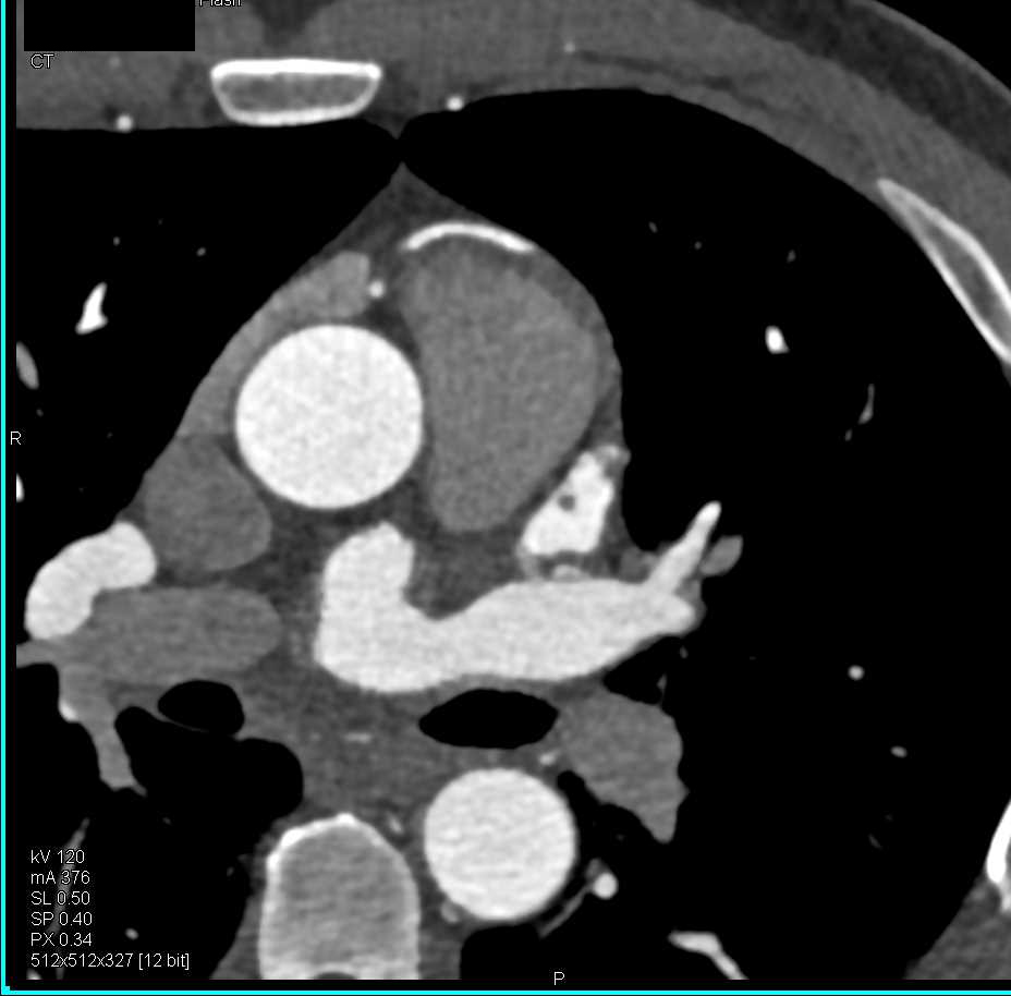 CCTA with Duplicated Left Anterior Descending Coronary Artery (LAD) - CTisus CT Scan