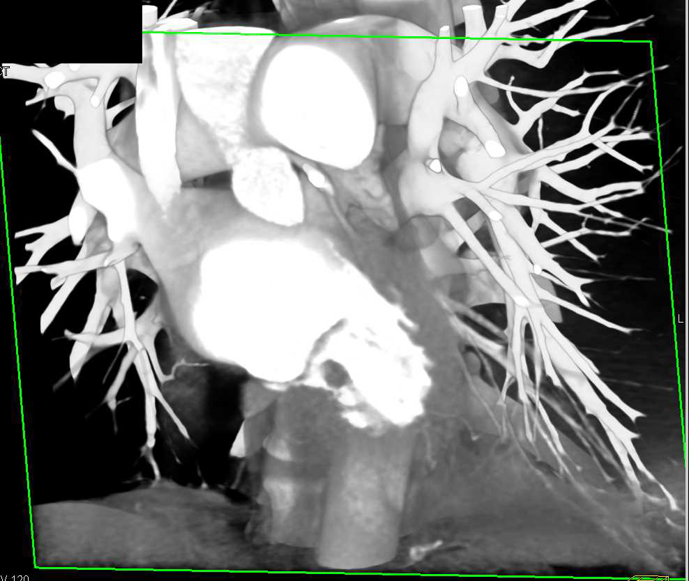 CCTA: Left Anterior Descending Artery (LAD) Plaque Including Calcified Plaque - CTisus CT Scan