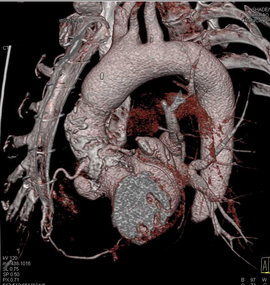 Pseudoaneurysm Aortic Root near Root Repair - CTisus CT Scan