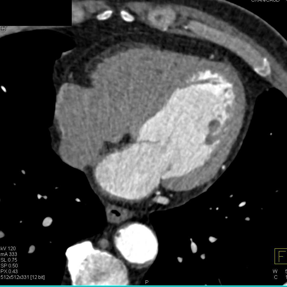 CCTA: Left Anterior Descending Coronary Artery (LAD) plaque and Circumflex Stent - CTisus CT Scan