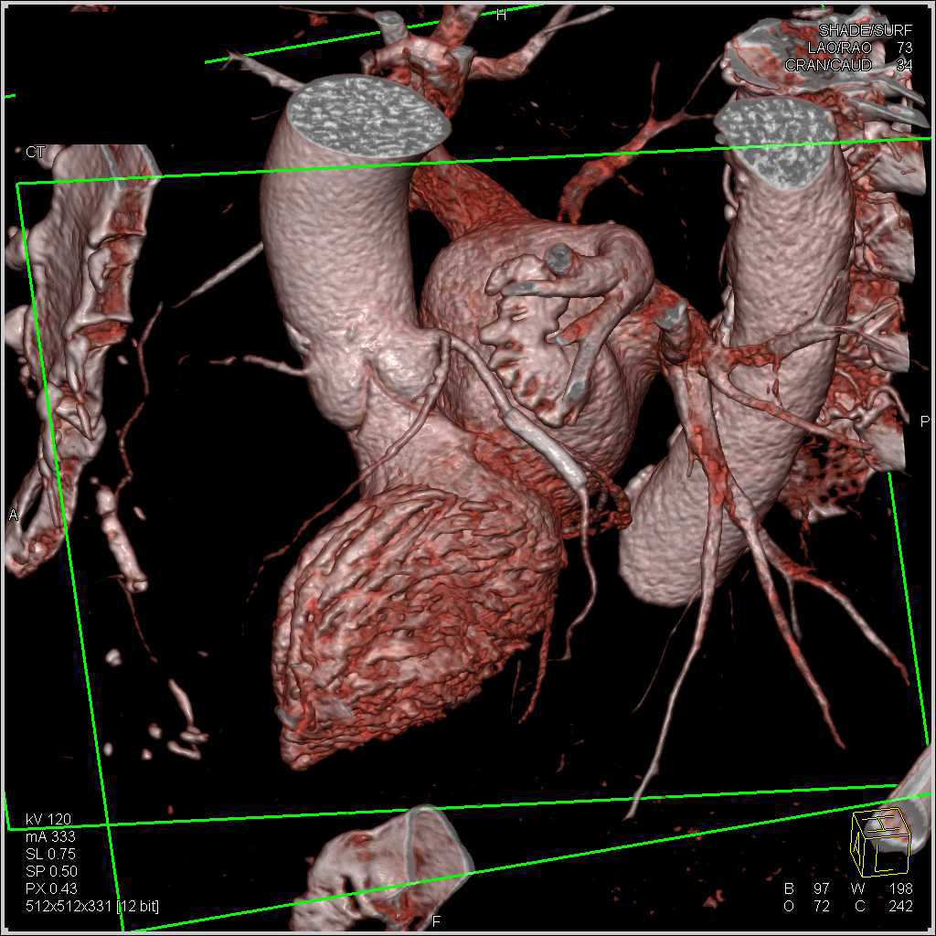 CCTA: Left Anterior Descending Coronary Artery (LAD) plaque and Circumflex Stent - CTisus CT Scan