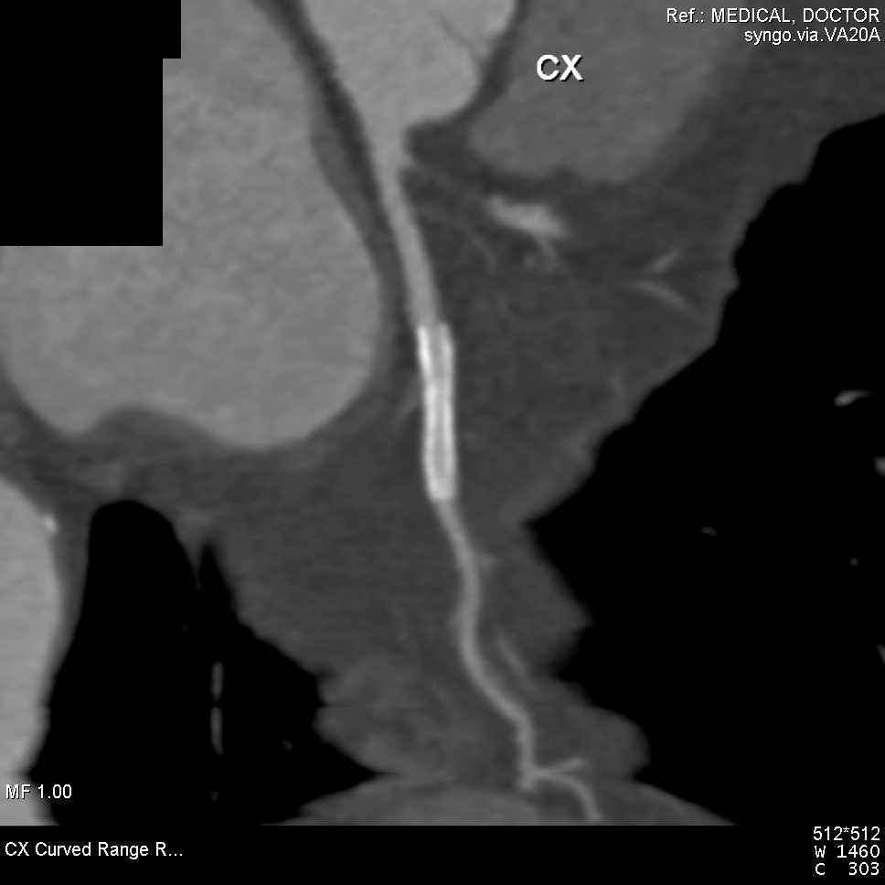 CCTA: Left Anterior Descending Coronary Artery (LAD) plaque and Circumflex Stent - CTisus CT Scan