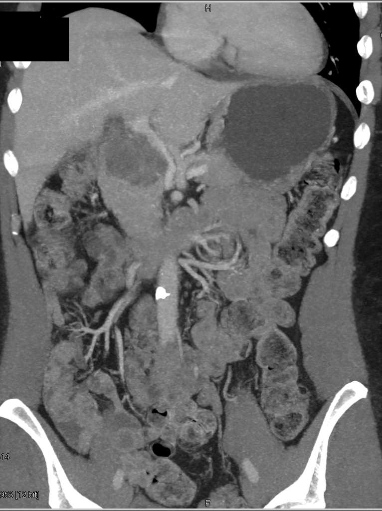 Incidental Cystadenoma Pancreas in a Patient Evaluated for Transcatheter Aortic Valve Replacement (TAVR) Procedure - CTisus CT Scan