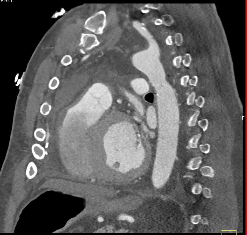 Aortic Valve Replacement (AVR) and Coarctation of the Aorta Repair - CTisus CT Scan