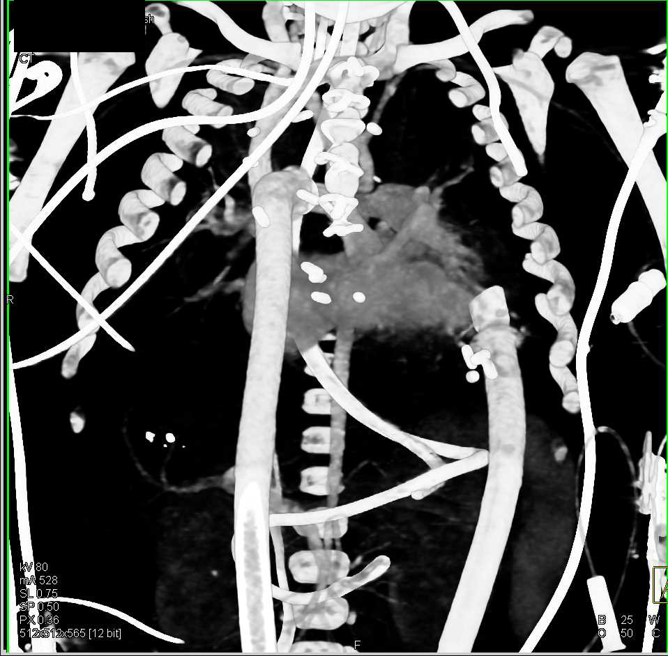 Vascular Grafts to Cardiac Pump - CTisus CT Scan