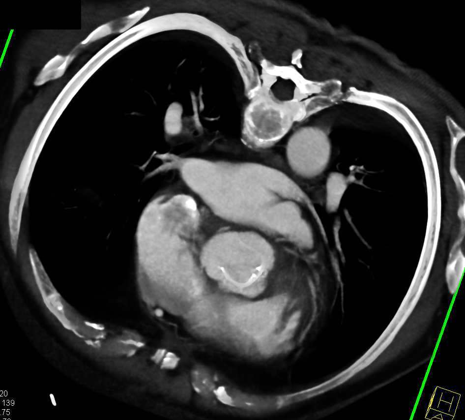 3D of Implanted Aortic Valve - CTisus CT Scan