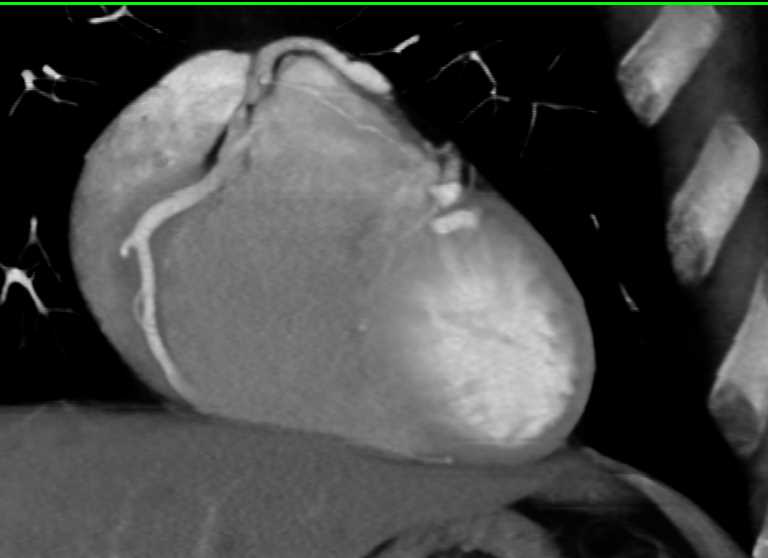 CCTA: Anomalous Origin of the Right Coronary Artery off the Pulmonary Artery (ARCAPA) - CTisus CT Scan