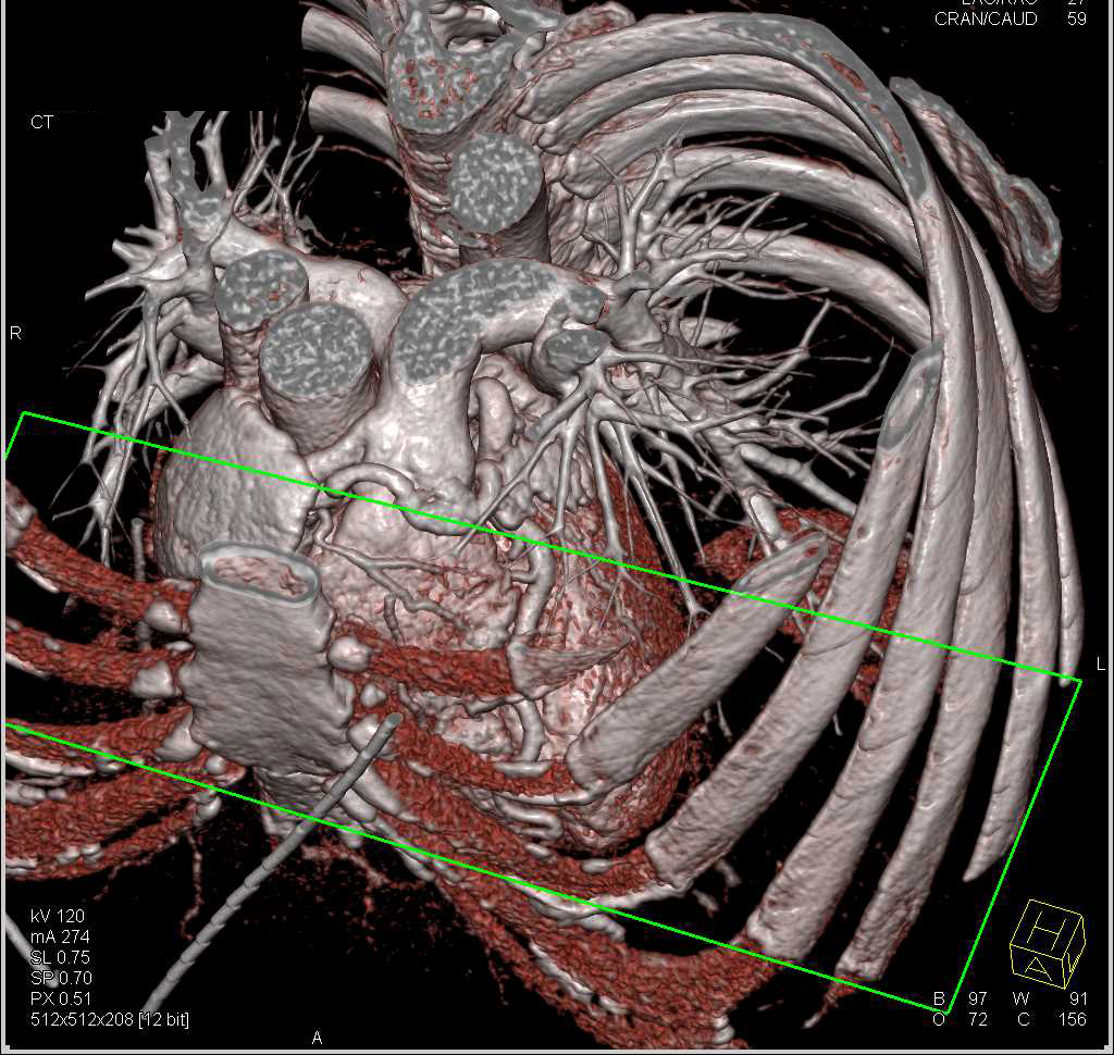 CCTA: Anomalous Origin of the Right Coronary Artery off the Pulmonary Artery (ARCAPA) - CTisus CT Scan