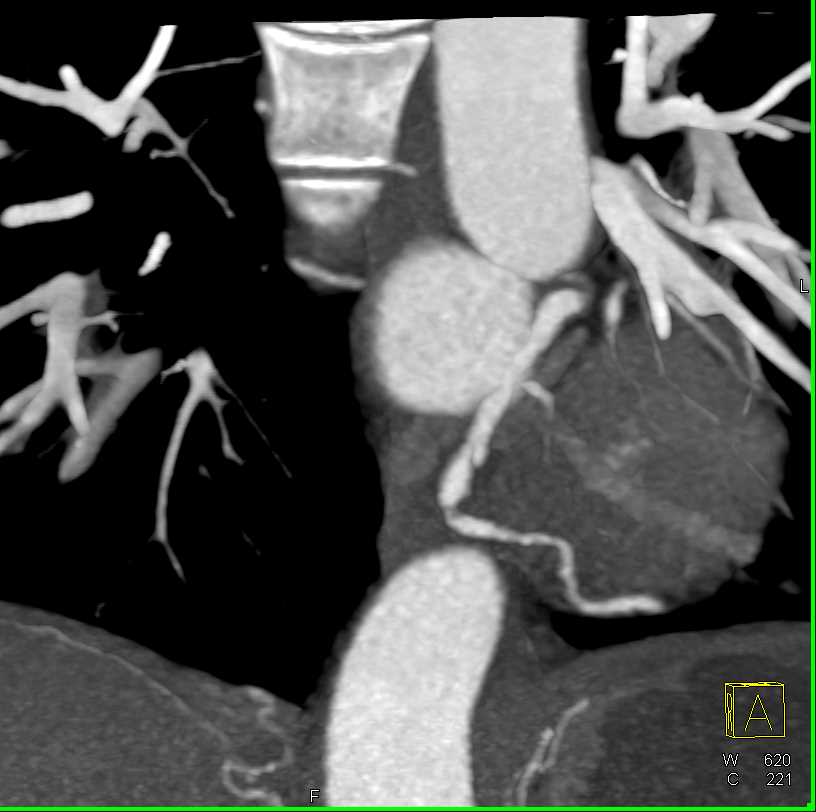 Multiple Coronary Artery Aneurysms in a Patient with a History of Intravenous Drug Abuse (IVDA) - CTisus CT Scan