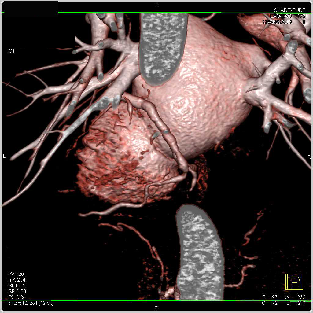 Multiple Coronary Artery Aneurysms in a Patient with a History of Intravenous Drug Abuse (IVDA) - CTisus CT Scan