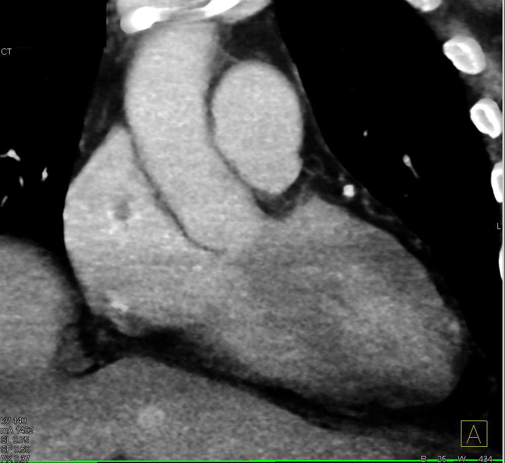 Incidental Clot in the Right Atrium - CTisus CT Scan