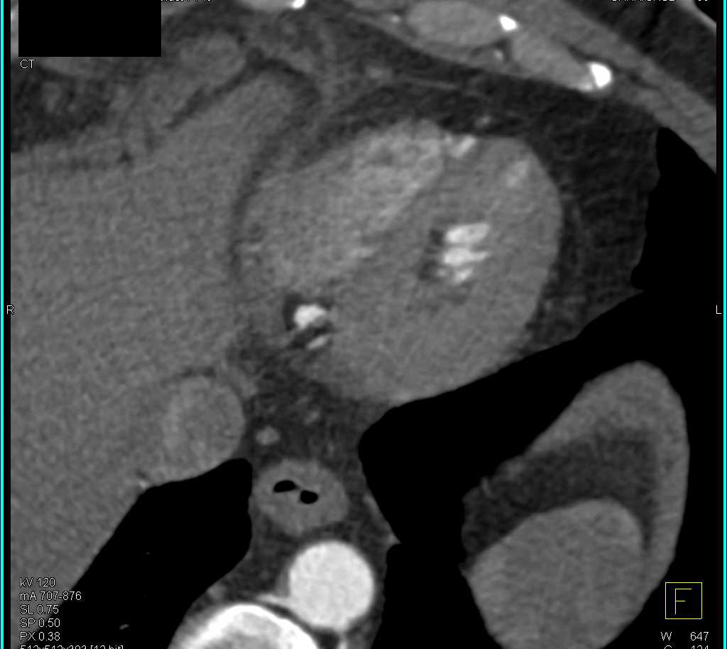 Right Coronary Artery Aneurysms - CTisus CT Scan