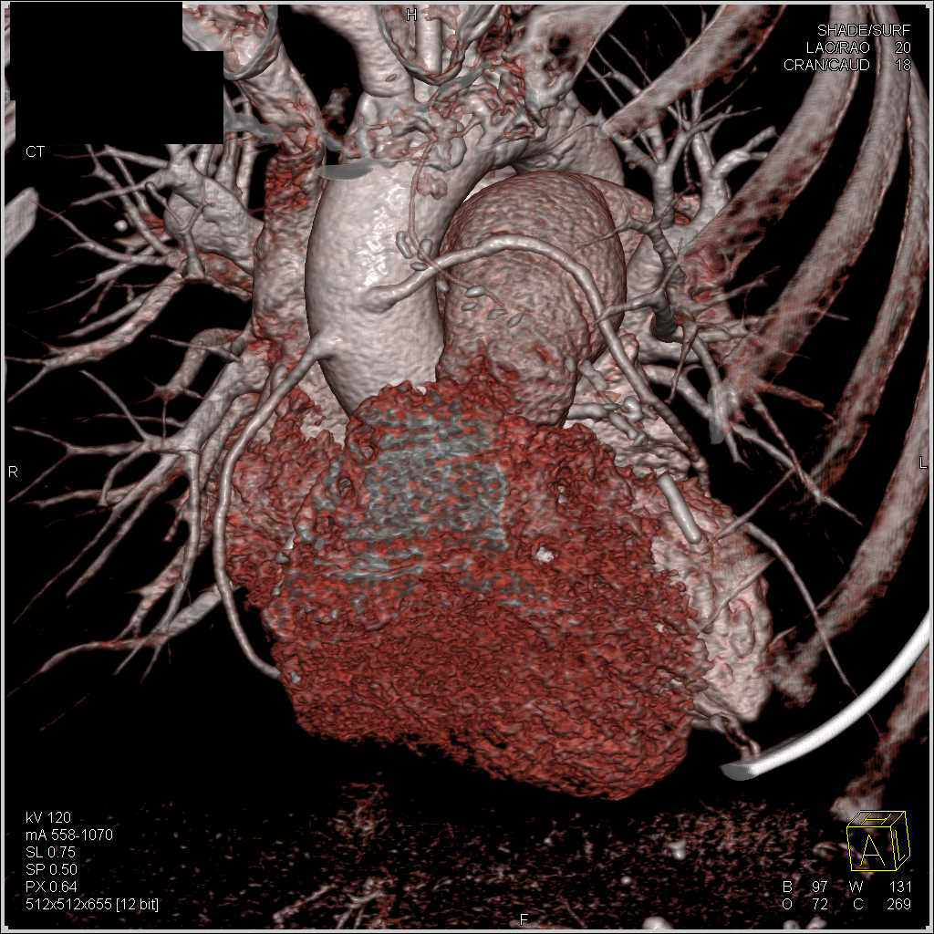 3D Visualization of 2 venous and 1 Left Internal Mammary Artery (LIMA) Graft - CTisus CT Scan