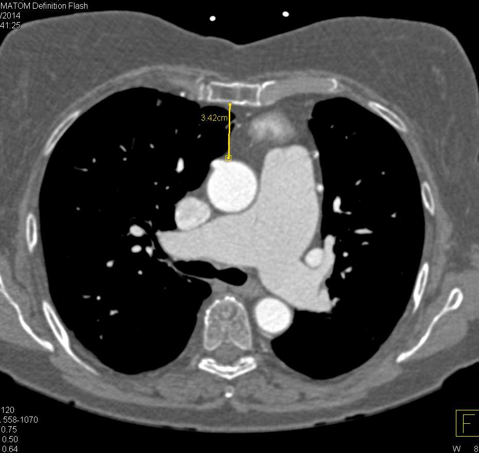 Thickening Aortic Valve and Valvular Disease - CTisus CT Scan