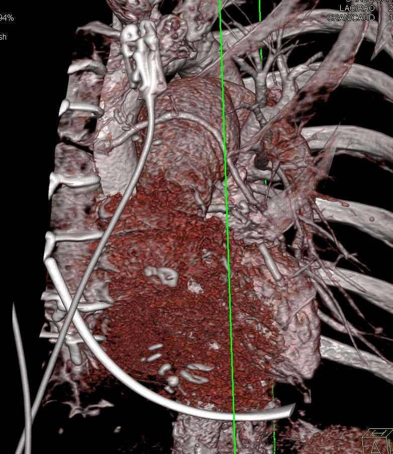 3D of Left Internal Mammary Artery (LIMA) and Venous Grafts - CTisus CT Scan