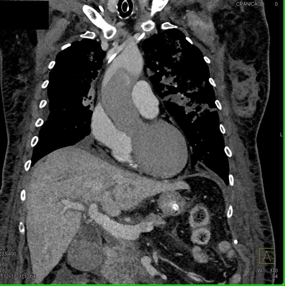 Acute Respiratory Distress Syndrome (ARDS) with Poor Cardiac Output - CTisus CT Scan