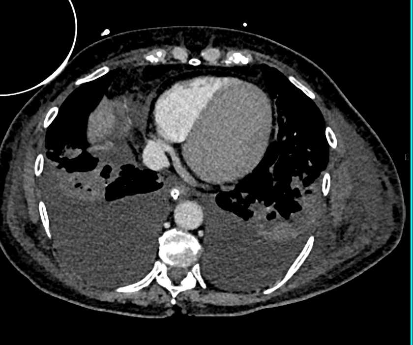 Acute Respiratory Distress Syndrome (ARDS) with Poor Cardiac Output and Unusual Ascending Aorta - CTisus CT Scan